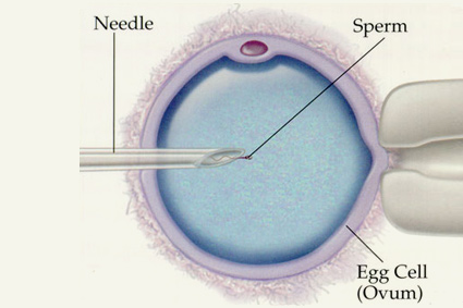 ICSI - Intracytoplasmic Sperm Injection