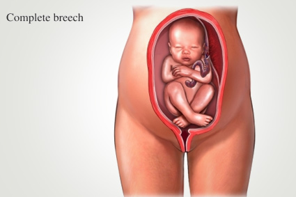 Breech Baby Delivery
