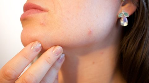 Acne, A Devastating Complication of PCOS